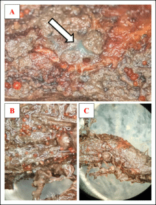 Soybean sample collected in Illinois. A) Blue-white spore masses of Fusarium virguliforme, the causal agent of sudden death syndrome (SDS). B) Red perithecia of Calonectria ilicicola observed on the same soybean stem and crown. C) Soybean stem showing co-infection by both pathogens.
